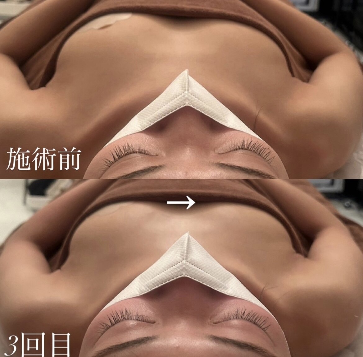 小顔症例